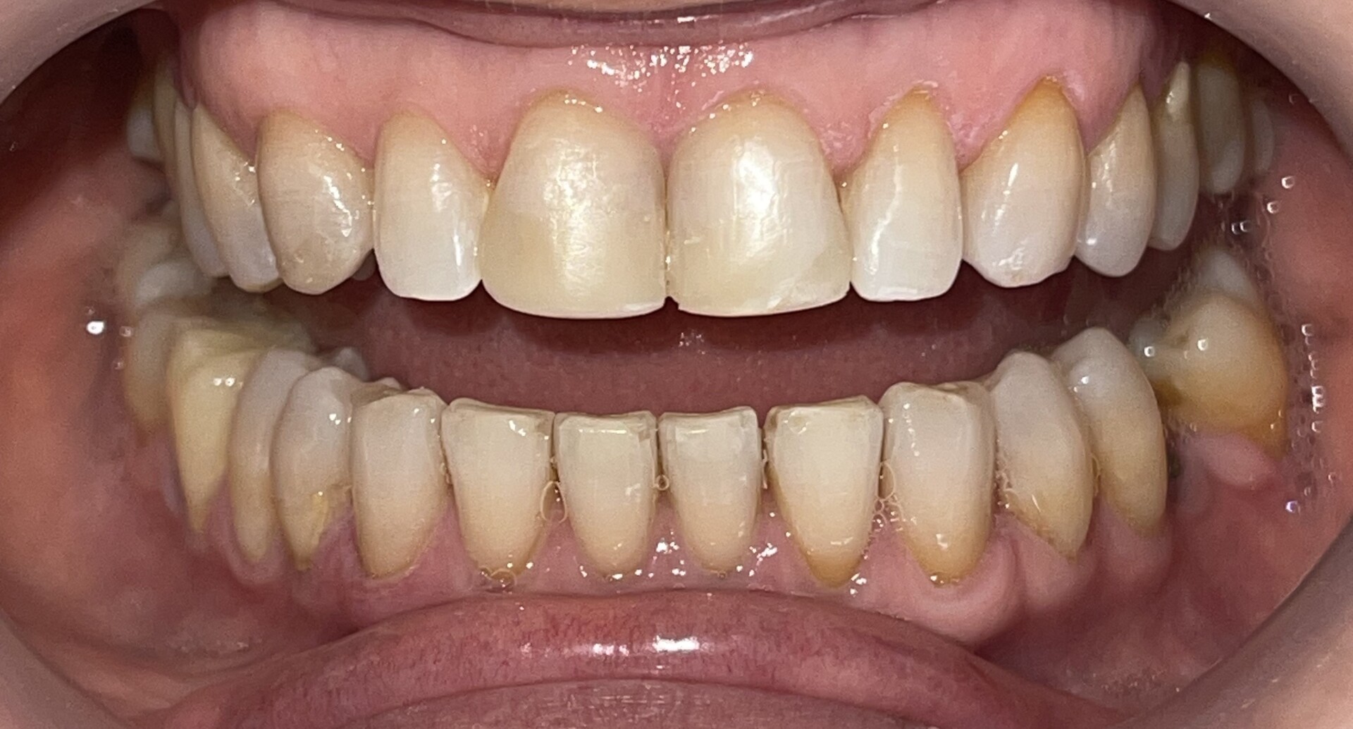 Aclaramiento Dental