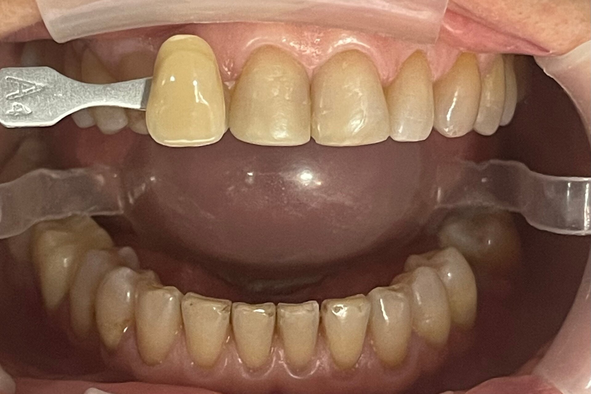 Aclaramiento Dental
